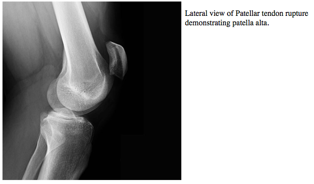 Patellar Tendon Rupture M66.269 727.66 eORIF